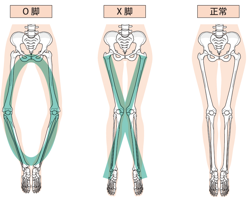 O脚が及ぼす影響とは？健康への悪影響と対策　～美馬接骨院から健康豆知識～